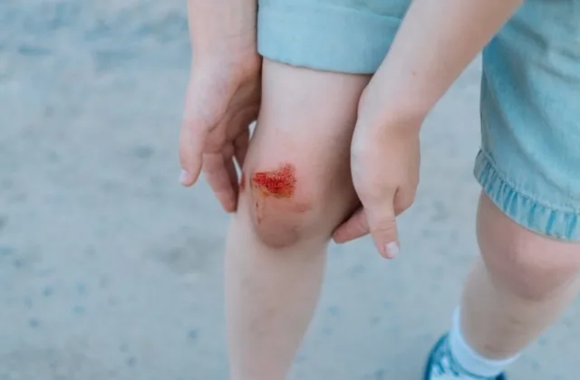 Kūno kultūros pamoka baigėsi trauma: kada mėlynė ar nubrozdinimas gali slėpti rimtesnę problemą